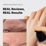 COSRX Advanced Snail 96 Mucin Power Essence before and after results – improves acne scars, smooths skin texture, and restores hydration.