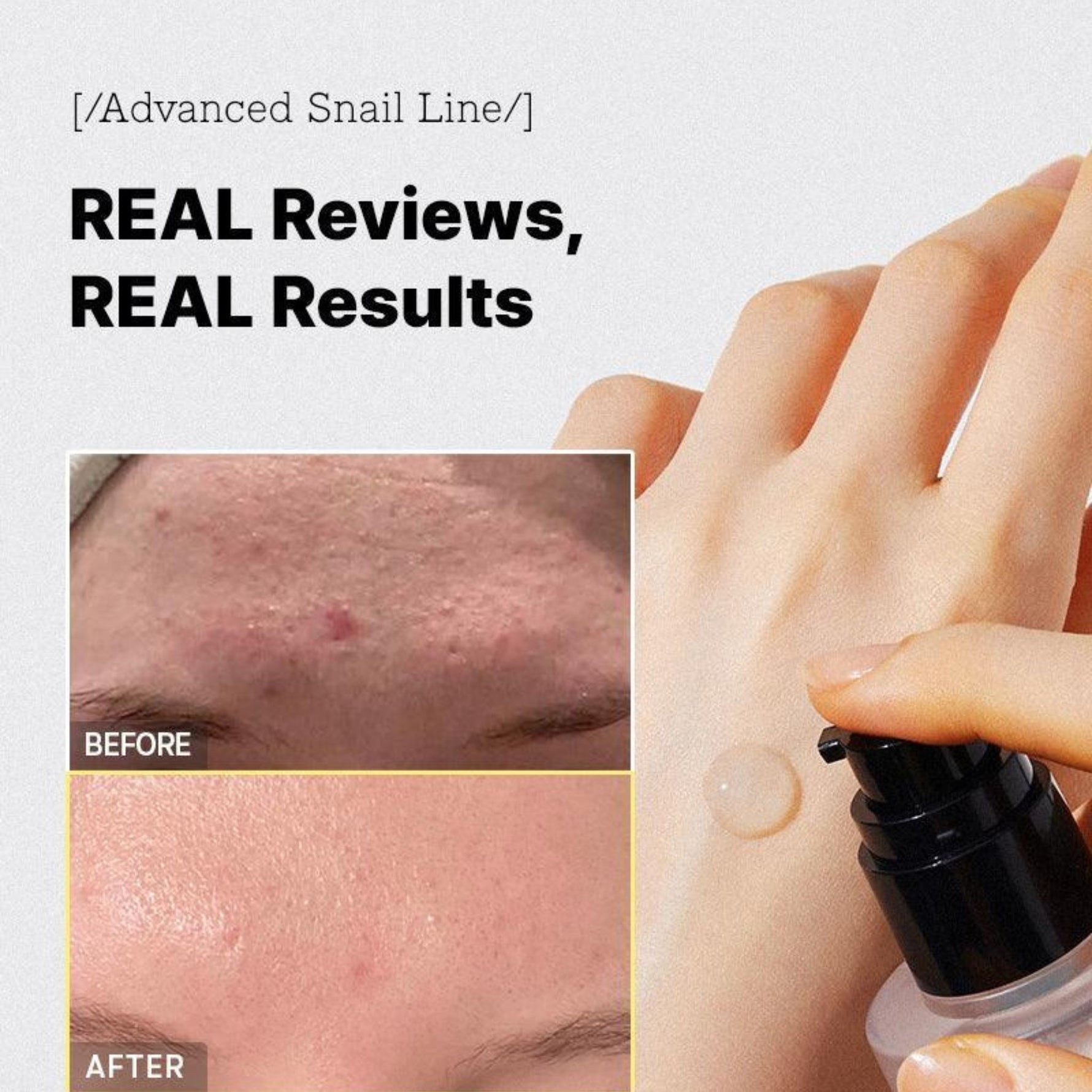 COSRX Advanced Snail 96 Mucin Power Essence before and after results – improves acne scars, smooths skin texture, and restores hydration.